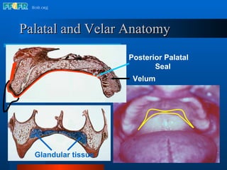 Palatal and Velar Anatomy Posterior Palatal Seal Velum Glandular tissue 