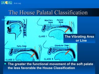 The House Palatal Classification The greater the functional movement of the soft palate the less favorable the House Classification The Vibrating Area or Line 