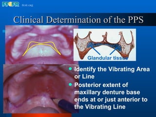Clinical Determination of the PPS Identify the Vibrating Area or Line Glandular tissue Posterior extent of maxillary denture base ends at or just anterior to the Vibrating Line 