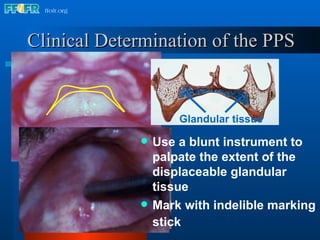 Clinical Determination of the PPS Use a blunt instrument to palpate the extent of the displaceable glandular tissue Mark with indelible marking stick Glandular tissue 