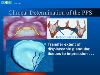 Clinical Determination of the PPS Transfer extent of displaceable glandular tissues to impression . . . Glandular tissue 