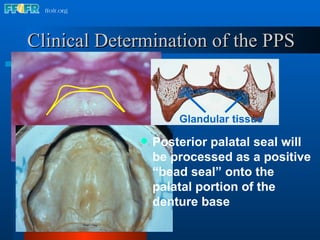 Clinical Determination of the PPS Posterior palatal seal will be processed as a positive “bead seal” onto the palatal portion of the denture base Glandular tissue 