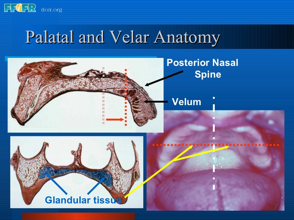 26.posterior palatal seal