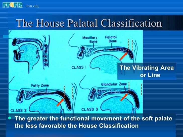 26.posterior palatal seal
