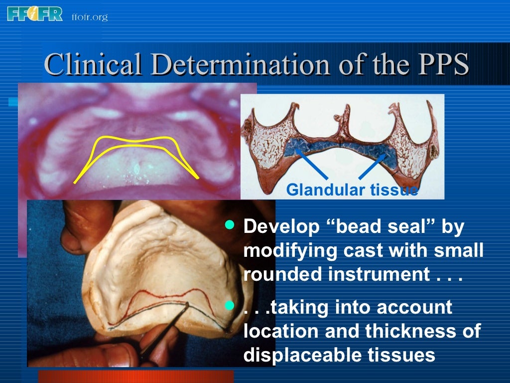 26.posterior palatal seal