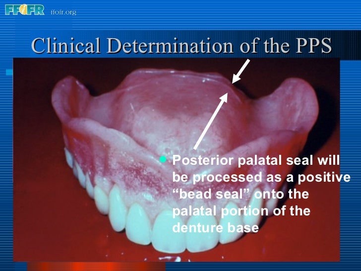 26.posterior palatal seal