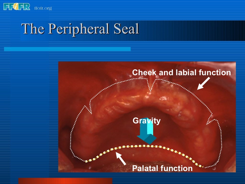 26.posterior palatal seal
