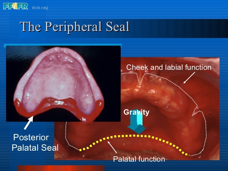 posterior palatal seal