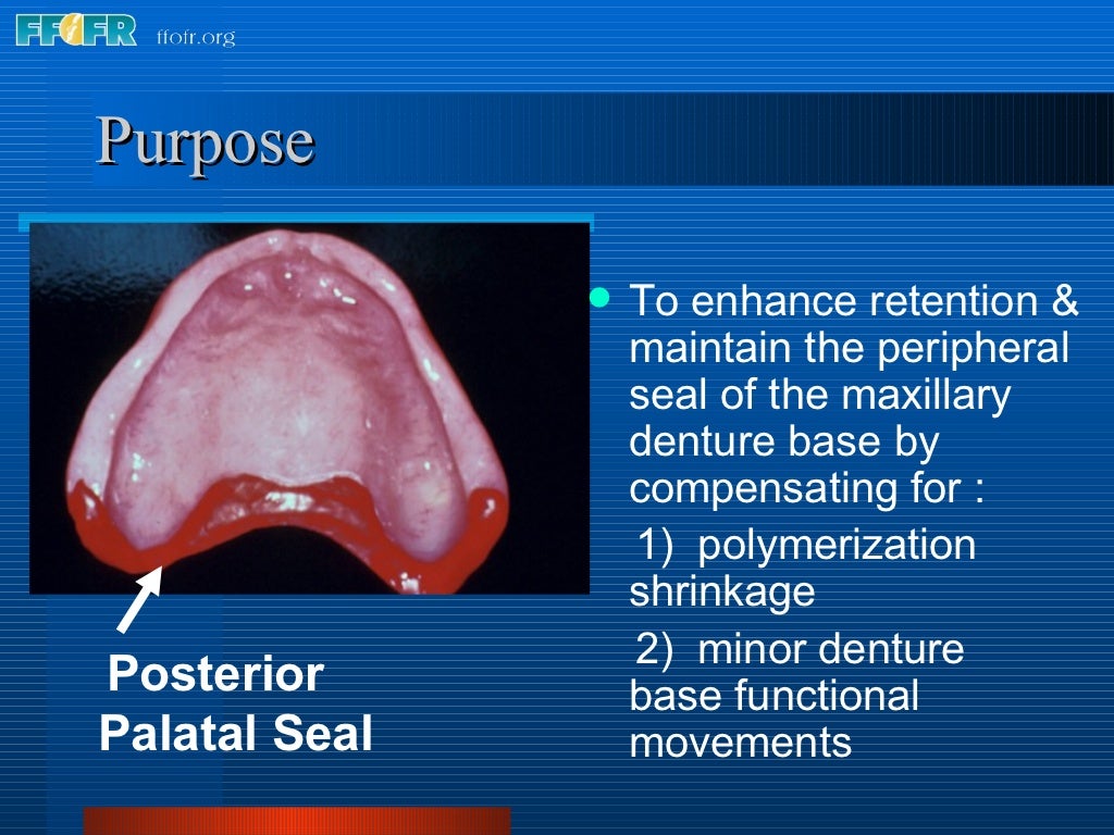 26.posterior palatal seal