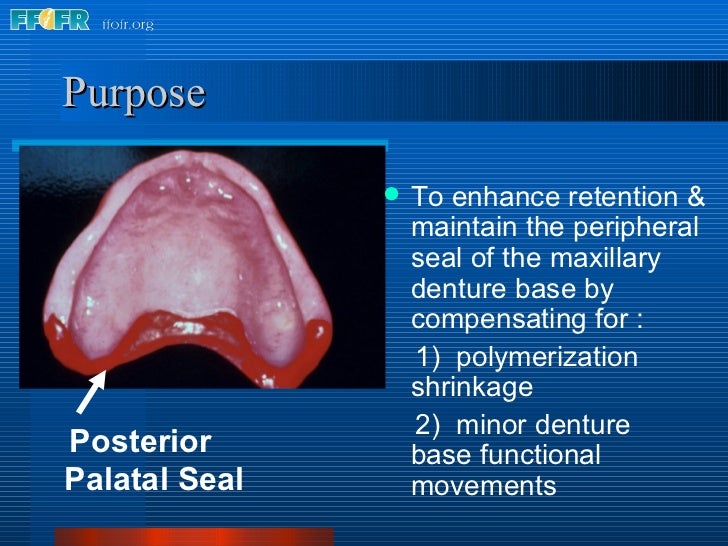 posterior palatal seal