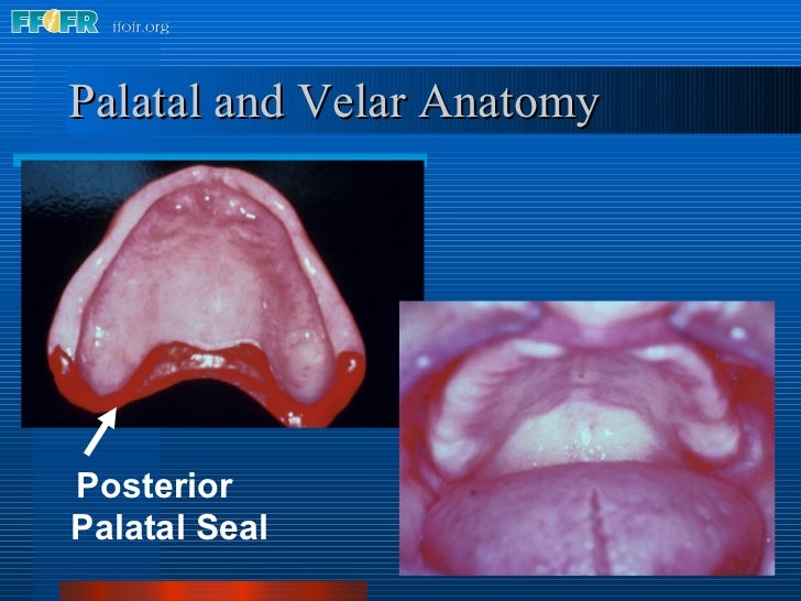 posterior palatal seal