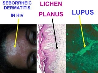 SEBORRHEIC 
DERMATITIS 
IN HIV 
LICHEN 
PLANUS LUPUS 
 