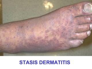 STASIS DERMATITIS 
 