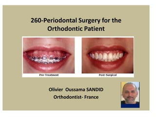 260-Periodontal Surgery for the
Orthodontic Patient
Olivier Oussama SANDID
Orthodontist- France
 
