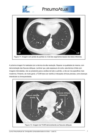 Figura 11. Imagem com janela de pulmão no nível dos segmentos basais dos lobos inferiores. 
A próxima imagem foi realizada com a técnica de alta resolução. Reparar na qualidade da mesma, com 
demonstração das fissuras oblíquas. Lembrar que, pela espessura do corte, esta técnica é feita com 
imagens intervaladas, não se prestando para a análise de todo o pulmão, a não ser nos aparelhos mais 
modernos. Portanto, de modo geral, a TCAR deve ser restrita a indicações clínicas precisas, como doenças 
intersticiais ou bronquiectasias. 
Figura 12. Imagem de TCAR demonstrando as fissuras oblíquas. 
Curso PneumoAtual de Tomografia computadorizada do tórax – aula 01 7 
 