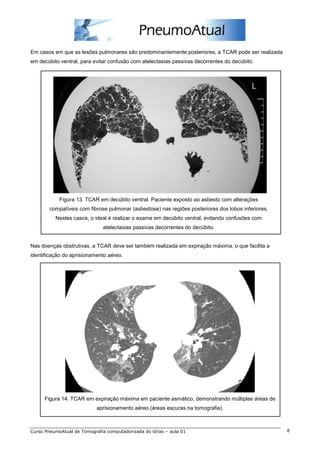 Em casos em que as lesões pulmonares são predominantemente posteriores, a TCAR pode ser realizada 
em decúbito ventral, para evitar confusão com atelectasias passivas decorrentes do decúbito. 
Figura 13. TCAR em decúbito ventral. Paciente exposto ao asbesto com alterações 
compatíveis com fibrose pulmonar (asbestose) nas regiões posteriores dos lobos inferiores. 
Nestes casos, o ideal é realizar o exame em decúbito ventral, evitando confusões com 
atelectasias passivas decorrentes do decúbito. 
Nas doenças obstrutivas, a TCAR deve ser também realizada em expiração máxima, o que facilita a 
identificação do aprisionamento aéreo. 
Figura 14. TCAR em expiração máxima em paciente asmático, demonstrando múltiplas áreas de 
aprisionamento aéreo (áreas escuras na tomografia). 
Curso PneumoAtual de Tomografia computadorizada do tórax – aula 01 8 
 