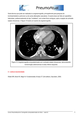 Outra técnica que pode ser realizada é a angiotomografia, principalmente para pesquisa de 
tromboembolismo pulmonar ou de outras alterações vasculares. O exame deve ser feito em aparelhos 
helicoidais, preferencialmente do tipo "multislice", com cortes finos contíguos, após a injeção de contraste 
iodado intravenoso. A figura 15 ilustra um exame de angiotomografia. 
Figura 15. Angiotomografia computadorizada com contraste iodado intravenoso, demonstrando 
má-formação arteriovenosa no lobo inferior esquerdo. 
3 – Leitura recomendada 
Webb WR, Brant W, Major N. Fundamentals of body CT (3rd edition), Saunders, 2005. 
Curso PneumoAtual de Tomografia computadorizada do tórax – aula 01 9 

