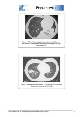 Figura 1. TC de tórax em paciente com pneumonia lobar por 
pneumococo.Consolidação com broncogramas aéreos no lobo 
inferior esquerdo. 
Figura 2. Infecção por Mycoplasma. Consolidação no lobo inferior 
direito, com margens mal definidas. 
Curso Pneumo Atual de Tomografia computadorizada do tórax – aula 02 2 
 
