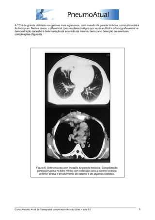 A TC é de grande utilidade nos germes mais agressivos, com invasão da parede torácica, como Nocardia e 
Actinomyces. Nestes casos, o diferencial com neoplasia maligna por vezes é difícil e a tomografia ajuda na 
demonstração da lesão e determinação da extensão da mesma, bem como detecção de eventuais 
complicações (figura 6). 
Figura 6. Actinomicose com invasão da parede torácica. Consolidação 
parenquimatosa no lobo médio com extensão para a parede torácica 
anterior direita e envolvimento do esterno e de algumas costelas. 
Curso Pneumo Atual de Tomografia computadorizada do tórax – aula 02 5 
 