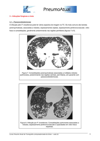 3 – Infecções fúngicas e virais 
3.1 – Paracoccidioidomicose 
A infecção pelo P. brasiliensis pode ter vários aspectos de imagem na TC. Os mais comuns são bandas 
parenquimatosas, associadas a nódulos, espessamentos septais, espessamento peribroncovascular, vidro 
fosco e consolidações, geralmente predominando nas regiões perihilares (figuras 7 e 8). 
Figura 7. Consolidações parenquimatosas associadas a múltiplos nódulos 
pulmonares, predominando nas regiões centrais, peri-hilares, em paciente com 
paracoccidioidomicose. 
Figura 8. Infecção por P. brasiliensis. Consolidações pulmonares associadas a 
nódulos, espessamento peribroncovascular e opacidades em vidro fosco 
esparsas. 
Curso Pneumo Atual de Tomografia computadorizada do tórax – aula 02 6 
 