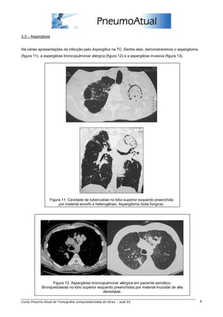 3.3 – Aspergilose 
Há várias apresentações da infecção pelo Aspergillus na TC. Dentre elas, demonstraremos o aspergiloma 
(figura 11), a aspergilose broncopulmonar alérgica (figura 12) e a aspergilose invasiva (figura 13). 
Figura 11. Cavidade de tuberculose no lobo superior esquerdo preenchida 
por material amorfo e heterogêneo. Aspergiloma (bola fúngica). 
Figura 12. Aspergilose broncopulmonar alérgica em paciente asmático. 
Bronquiectasias no lobo superior esquerdo preenchidas por material mucóide de alta 
densidade. 
Curso Pneumo Atual de Tomografia computadorizada do tórax – aula 02 8 
 