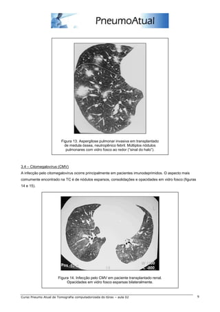 Figura 13. Aspergilose pulmonar invasiva em transplantado 
de medula óssea, neutropênico febril. Múltiplos nódulos 
pulmonares com vidro fosco ao redor (“sinal do halo”). 
3.4 – Citomegalovírus (CMV) 
A infecção pelo citomegalovírus ocorre principalmente em pacientes imunodeprimidos. O aspecto mais 
comumente encontrado na TC é de nódulos esparsos, consolidações e opacidades em vidro fosco (figuras 
14 e 15). 
Figura 14. Infecção pelo CMV em paciente transplantado renal. 
Opacidades em vidro fosco esparsas bilateralmente. 
Curso Pneumo Atual de Tomografia computadorizada do tórax – aula 02 9 
 