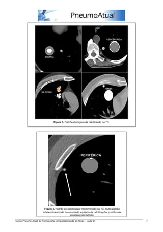 Figura 3. Padrões benignos de calcificação na TC. 
Figura 4. Padrão de calcificação indeterminado na TC. Outro padrão 
indeterminado (não demonstrado aqui) é o de calcificações puntiformes 
esparsas pelo nódulo. 
Curso Pneumo Atual de Tomografia computadorizada do tórax – aula 04 3 
 
