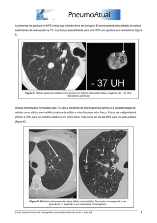 A presença de gordura no NPS indica que a lesão deve ser benigna. É demonstrada pelo achado de baixos 
coeficientes de atenuação na TC. A principal possibilidade para um NPS com gordura é o hamartoma (figura 
5). 
Figura 5. Nódulo pulmonar solitário com gordura no interior (densidade baixa, negativa, de – 37 UH). 
Hamartoma pulmonar. 
Outras informações fornecidas pela TC são a presença de broncogramas aéreos e a caracterização do 
nódulo como sólido, semi-sólido (mistura de sólido e vidro fosco) e vidro fosco. A taxa de malignidade é 
inferior a 10% para os nódulos sólidos e em vidro fosco, mas pode ser de até 60% para os semi-sólidos 
(figura 6). 
Figura 6. Nódulos pulmonares dos tipos sólido e semi-sólido. O primeiro correspondia a um 
granuloma; o segundo, a um carcinoma broncogênico. 
Curso Pneumo Atual de Tomografia computadorizada do tórax – aula 04 4 
 