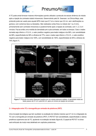 A TC pode ainda fornecer maiores informações quando utilizado o protocolo de estudo dinâmico do nódulo 
após a injeção de contraste iodado intravenoso. Desenvolvido pelo Dr. Swensen, na Clínica Mayo, este 
protocolo pode ser usado para aquele NPS maior que 0,7 cm e menor que 3,0 cm, sem calcificações ou 
gordura, com contornos lisos ou lobulados. São realizados cortes finos no nódulo (de 1 ou 3 mm), 
primeiramente sem contraste intravenoso e posteriormente após a injeção do contraste, com 1, 2, 3 e 4 
minutos. Faz-se então uma medida de densidade pré e pós-contraste, em todos os tempos. Caso o realce 
da lesão seja inferior a 15 U.H., o valor preditivo negativo para lesão maligna é de 96%, com sensibilidade 
de 98%, especificidade de 58% e eficácia de 77%; caso o realce seja inferior a 10 U.H., o valor preditivo 
negativo para lesão maligna é de 100%, com sensibilidade de 100%, especificidade de 50% e eficácia de 
74% (figura 7). 
Figura 7. Protocolo de realce (Swensen) positivo em um nódulo pulmonar solitário. A densidade média da 
lesão passou de 21 U.H. para 82 U.H. após um minuto da injeção de contraste. 
3 – Integração entre TC e tomografia por emissão de pósitrons (PET) 
Uma inovação tecnológica que tem auxiliado na avaliação de nódulos maiores que 0,7 cm é a integração da 
TC com a tomografia por emissão de pósitrons (PET). A PET/CT tem sensibilidade, especificidade e valores 
preditivos superiores aos da TC, ajudando na avaliação da lesão (figura 8). O papel da PET/CT no tórax 
será enfocado de modo mais detalhado em capítulos posteriores. 
Curso Pneumo Atual de Tomografia computadorizada do tórax – aula 04 5 
 