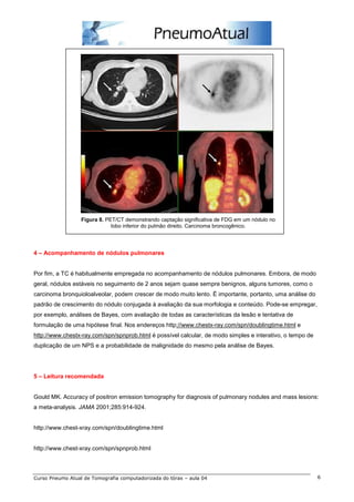 Figura 8. PET/CT demonstrando captação significativa de FDG em um nódulo no 
lobo inferior do pulmão direito. Carcinoma broncogênico. 
4 – Acompanhamento de nódulos pulmonares 
Por fim, a TC é habitualmente empregada no acompanhamento de nódulos pulmonares. Embora, de modo 
geral, nódulos estáveis no seguimento de 2 anos sejam quase sempre benignos, alguns tumores, como o 
carcinoma bronquioloalveolar, podem crescer de modo muito lento. É importante, portanto, uma análise do 
padrão de crescimento do nódulo conjugada à avaliação da sua morfologia e conteúdo. Pode-se empregar, 
por exemplo, análises de Bayes, com avaliação de todas as características da lesão e tentativa de 
formulação de uma hipótese final. Nos endereços http://www.chestx-ray.com/spn/doublingtime.html e 
http://www.chestx-ray.com/spn/spnprob.html é possível calcular, de modo simples e interativo, o tempo de 
duplicação de um NPS e a probabilidade de malignidade do mesmo pela análise de Bayes. 
5 – Leitura recomendada 
Gould MK. Accuracy of positron emission tomography for diagnosis of pulmonary nodules and mass lesions: 
a meta-analysis. JAMA 2001;285:914-924. 
http://www.chest-xray.com/spn/doublingtime.html 
http://www.chest-xray.com/spn/spnprob.html 
Curso Pneumo Atual de Tomografia computadorizada do tórax – aula 04 6 
 