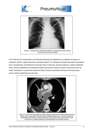 Figura 12. Alargamento mediastinal bilateral na radiografia simples (setas). 
Carcinoma de pequenas células. 
A TC evidencia com propriedade o envolvimento linfonodal, principalmente na avaliação da doença no 
mediastino anterior, região subcarinal e pericárdica (figura 13). Caracteriza achados associados importantes 
para o estadiamento: acometimento de grandes vasos e brônquios, derrames pleurais, invasão mediastinal 
direta, doença metastática e principalmente lesões pulmonares ocultas ao estudo convencional, além de 
melhor caracterizar o componente tecidual da lesão. Embora compressão brônquica extrínseca possa 
ocorrer, lesões endobrônquicas são raras. 
Figura 13. Carcinoma de pequenas células. Massa central envolvendoa artéria pulmonar 
direita (seta), associada a derrame pleural ipsilateral(asterisco). O comprometimento 
mediastinal ocasionando a síndrome daveia cava superior pela compressão tumoral, 
trombose ou invasão diretaocorre principalmente por este tipo tumoral. 
Curso Pneumo Atual de Tomografia computadorizada do tórax – aula 05 10 
 