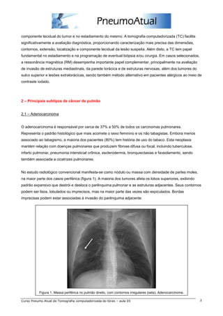 componente tecidual do tumor e no estadiamento do mesmo. A tomografia computadorizada (TC) facilita 
significativamente a avaliação diagnóstica, proporcionando caracterização mais precisa das dimensões, 
contornos, extensão, localização e componente tecidual da lesão suspeita. Além disto, a TC tem papel 
fundamental no estadiamento e na programação de eventual biópsia e/ou cirurgia. Em casos selecionados, 
a ressonância magnética (RM) desempenha importante papel complementar, principalmente na avaliação 
de invasão de estruturas mediastinais, da parede torácica e de estruturas nervosas, além dos tumores do 
sulco superior e lesões extratorácicas, sendo também método alternativo em pacientes alérgicos ao meio de 
contraste iodado. 
2 – Principais subtipos de câncer de pulmão 
2.1 – Adenocarcinoma 
O adenocarcinoma é responsável por cerca de 37% a 50% de todos os carcinomas pulmonares. 
Representa o padrão histológico que mais acomete o sexo feminino e os não tabagistas. Embora menos 
associado ao tabagismo, a maioria dos pacientes (80%) tem história de uso do tabaco. Esta neoplasia 
mantém relação com doenças pulmonares que produzem fibrose difusa ou focal, incluindo tuberculose, 
infarto pulmonar, pneumonia intersticial crônica, esclerodermia, bronquiectasias e faveolamento, sendo 
também associada a cicatrizes pulmonares. 
No estudo radiológico convencional manifesta-se como nódulo ou massa com densidade de partes moles, 
na maior parte dos casos periférica (figura 1). A maioria dos tumores afeta os lobos superiores, exibindo 
padrão expansivo que destrói e desloca o parênquima pulmonar e as estruturas adjacentes. Seus contornos 
podem ser lisos, lobulados ou imprecisos, mas na maior parte das vezes são espiculados. Bordas 
imprecisas podem estar associadas à invasão do parênquima adjacente. 
Figura 1. Massa periférica no pulmão direito, com contornos irregulares (seta). Adenocarcinoma. 
Curso Pneumo Atual de Tomografia computadorizada do tórax – aula 05 2 
 