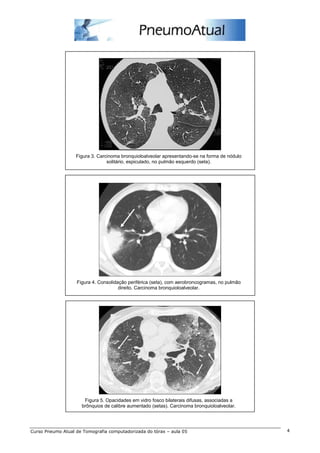 Figura 3. Carcinoma bronquioloalveolar apresentando-se na forma de nódulo 
solitário, espiculado, no pulmão esquerdo (seta). 
Figura 4. Consolidação periférica (seta), com aerobroncogramas, no pulmão 
direito. Carcinoma bronquioloalveolar. 
Figura 5. Opacidades em vidro fosco bilaterais difusas, associadas a 
brônquios de calibre aumentado (setas). Carcinoma bronquioloalveolar. 
Curso Pneumo Atual de Tomografia computadorizada do tórax – aula 05 4 
 