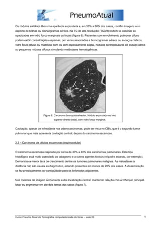 Os nódulos solitários têm uma aparência espiculada e, em 50% a 60% dos casos, contêm imagens com 
aspecto de bolhas ou broncogramas aéreos. Na TC de alta resolução (TCAR) podem se associar as 
opacidades em vidro fosco marginais ou focais (figura 6). Pacientes com envolvimento pulmonar difuso 
podem exibir consolidações esparsas, por vezes associadas a broncogramas aéreos ou espaços císticos, 
vidro fosco difuso ou multifocal com ou sem espessamento septal, nódulos centrolobulares do espaço aéreo 
ou pequenos nódulos difusos simulando metástases hematogênicas. 
Figura 6. Carcinoma bronquioloalveolar. Nódulo espiculado no lobo 
superior direito (seta), com vidro fosco marginal. 
Cavitação, apesar de infreqüente nos adenocarcinomas, pode ser vista no CBA, que é o segundo tumor 
pulmonar que mais apresenta cavitação central, depois do carcinoma escamoso. 
2.3 – Carcinoma de células escamosas (espinocelular) 
O carcinoma escamoso responde por cerca de 30% a 40% dos carcinomas pulmonares. Este tipo 
histológico está muito associado ao tabagismo e a outros agentes tóxicos (níquel e asbesto, por exemplo). 
Demonstra a menor taxa de crescimento dentre os tumores pulmonares malignos. As metástases à 
distância não são usuais ao diagnóstico, estando presentes em menos de 20% dos casos. A disseminação 
se faz principalmente por contigüidade para os linfonodos adjacentes. 
Nos métodos de imagem comumente exibe localização central, mantendo relação com o brônquio principal, 
lobar ou segmentar em até dois terços dos casos (figura 7). 
Curso Pneumo Atual de Tomografia computadorizada do tórax – aula 05 5 
 