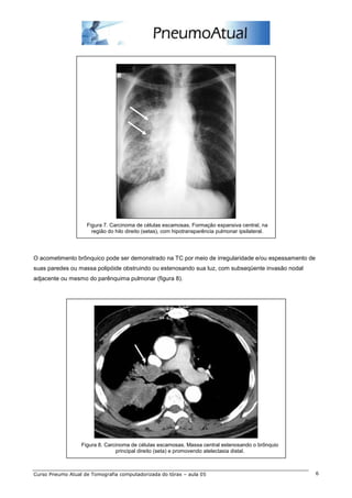 Figura 7. Carcinoma de células escamosas. Formação expansiva central, na 
região do hilo direito (setas), com hipotransparência pulmonar ipsilateral. 
O acometimento brônquico pode ser demonstrado na TC por meio de irregularidade e/ou espessamento de 
suas paredes ou massa polipóide obstruindo ou estenosando sua luz, com subseqüente invasão nodal 
adjacente ou mesmo do parênquima pulmonar (figura 8). 
Figura 8. Carcinoma de células escamosas. Massa central estenosando o brônquio 
principal direito (seta) e promovendo atelectasia distal. 
Curso Pneumo Atual de Tomografia computadorizada do tórax – aula 05 6 
 