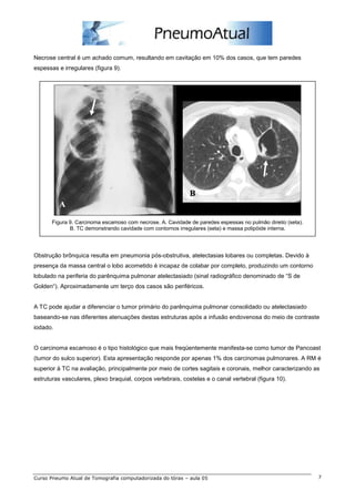 Necrose central é um achado comum, resultando em cavitação em 10% dos casos, que tem paredes 
espessas e irregulares (figura 9). 
Figura 9. Carcinoma escamoso com necrose. A. Cavidade de paredes espessas no pulmão direito (seta). 
B. TC demonstrando cavidade com contornos irregulares (seta) e massa polipóide interna. 
Obstrução brônquica resulta em pneumonia pós-obstrutiva, atelectasias lobares ou completas. Devido à 
presença da massa central o lobo acometido é incapaz de colabar por completo, produzindo um contorno 
lobulado na periferia do parênquima pulmonar atelectasiado (sinal radiográfico denominado de “S de 
Golden“). Aproximadamente um terço dos casos são periféricos. 
A TC pode ajudar a diferenciar o tumor primário do parênquima pulmonar consolidado ou atelectasiado 
baseando-se nas diferentes atenuações destas estruturas após a infusão endovenosa do meio de contraste 
iodado. 
O carcinoma escamoso é o tipo histológico que mais freqüentemente manifesta-se como tumor de Pancoast 
(tumor do sulco superior). Esta apresentação responde por apenas 1% dos carcinomas pulmonares. A RM é 
superior à TC na avaliação, principalmente por meio de cortes sagitais e coronais, melhor caracterizando as 
estruturas vasculares, plexo braquial, corpos vertebrais, costelas e o canal vertebral (figura 10). 
Curso Pneumo Atual de Tomografia computadorizada do tórax – aula 05 7 
 