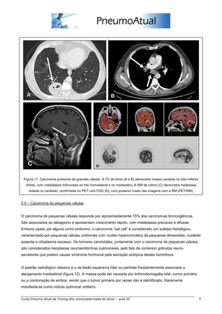 Figura 11. Carcinoma pulmonar de grandes células. A TC de tórax (A e B) demonstra massa cavitada no lobo inferior 
direito, com metástases linfonodais no hilo homolateral e no mediastino. A RM de crânio (C) demonstra metástase 
isolada no cerebelo, confirmada no PET com FDG (D), com posterior fusão das imagens com a RM (PET/RM). 
2.5 – Carcinoma de pequenas células 
O carcinoma de pequenas células responde por aproximadamente 15% dos carcinomas broncogênicos. 
São associados ao tabagismo e apresentam crescimento rápido, com metástases precoces e difusas. 
Embora usado por alguns como sinônimo, o carcinoma “oat cell” é considerado um subtipo histológico, 
caracterizado por pequenas células uniformes com núcleo hipercromático de pequenas dimensões, nucléolo 
ausente e citoplasma escasso. Os tumores carcinóides, juntamente com o carcinoma de pequenas células, 
são considerados neoplasias neuroendócrinas pulmonares, pelo fato de conterem grânulos neuro-secretores 
que podem causar síndrome hormonal pela secreção ectópica destes hormônios. 
O padrão radiológico clássico é o de lesão expansiva hilar ou perihilar freqüentemente associada a 
alargamento mediastinal (figura 12). A massa pode ser causada por linfonodomegalia hilar, tumor primário 
ou a combinação de ambos, sendo que o tumor primário por vezes não é identificado. Raramente 
manifesta-se como nódulo pulmonar solitário. 
Curso Pneumo Atual de Tomografia computadorizada do tórax – aula 05 9 
 