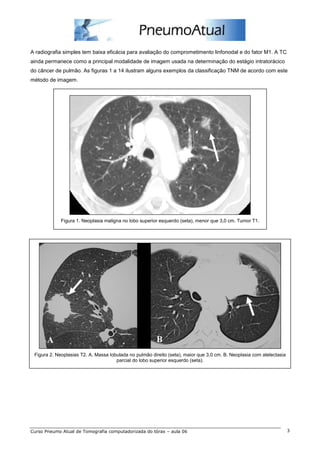 A radiografia simples tem baixa eficácia para avaliação do comprometimento linfonodal e do fator M1. A TC 
ainda permanece como a principal modalidade de imagem usada na determinação do estágio intratorácico 
do câncer de pulmão. As figuras 1 a 14 ilustram alguns exemplos da classificação TNM de acordo com este 
método de imagem. 
Figura 1. Neoplasia maligna no lobo superior esquerdo (seta), menor que 3,0 cm. Tumor T1. 
Figura 2. Neoplasias T2. A. Massa lobulada no pulmão direito (seta), maior que 3,0 cm. B. Neoplasia com atelectasia 
parcial do lobo superior esquerdo (seta). 
Curso Pneumo Atual de Tomografia computadorizada do tórax – aula 06 3 
 