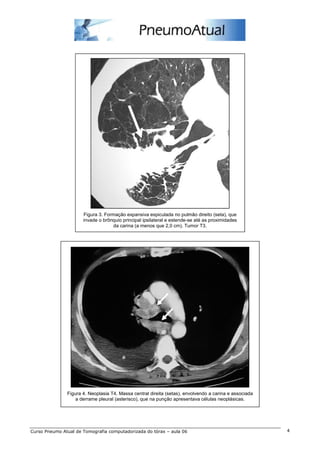 Figura 3. Formação expansiva espiculada no pulmão direito (seta), que 
invade o brônquio principal ipsilateral e estende-se até as proximidades 
da carina (a menos que 2,0 cm). Tumor T3. 
Figura 4. Neoplasia T4. Massa central direita (setas), envolvendo a carina e associada 
a derrame pleural (asterisco), que na punção apresentava células neoplásicas. 
Curso Pneumo Atual de Tomografia computadorizada do tórax – aula 06 4 
 