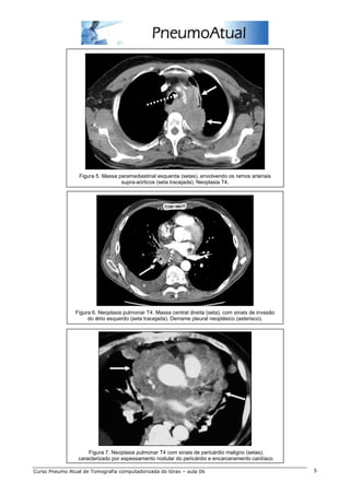 Figura 5. Massa paramediastinal esquerda (setas), envolvendo os ramos arteriais 
supra-aórticos (seta tracejada). Neoplasia T4. 
Figura 6. Neoplasia pulmonar T4. Massa central direita (seta), com sinais de invasão 
do átrio esquerdo (seta tracejada). Derrame pleural neoplásico (asterisco). 
Figura 7. Neoplasia pulmonar T4 com sinais de pericárdio maligno (setas), 
caracterizado por espessamento nodular do pericárdio e encarceramento cardíaco. 
Curso Pneumo Atual de Tomografia computadorizada do tórax – aula 06 5 
 