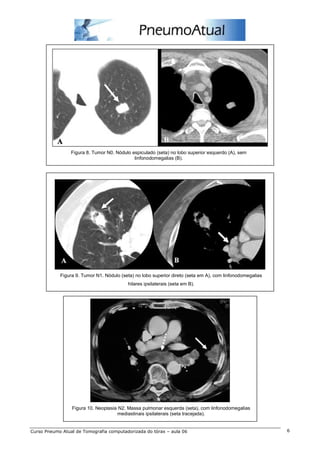 Figura 8. Tumor N0. Nódulo espiculado (seta) no lobo superior esquerdo (A), sem 
linfonodomegalias (B). 
Figura 9. Tumor N1. Nódulo (seta) no lobo superior direto (seta em A), com linfonodomegalias 
hilares ipsilaterais (seta em B). 
Figura 10. Neoplasia N2. Massa pulmonar esquerda (seta), com linfonodomegalias 
mediastinais ipsilaterais (seta tracejada). 
Curso Pneumo Atual de Tomografia computadorizada do tórax – aula 06 6 
 