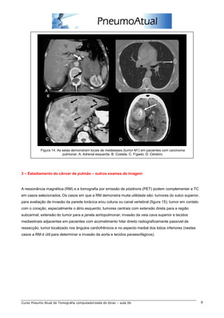 Figura 14. As setas demonstram locais de metástases (tumor M1) em pacientes com carcinoma 
pulmonar. A. Adrenal esquerda. B. Costela. C. Fígado. D. Cérebro. 
3 – Estadiamento do câncer de pulmão – outros exames de imagem 
A ressonância magnética (RM) e a tomografia por emissão de pósitrons (PET) podem complementar a TC 
em casos selecionados. Os casos em que a RM demonstra muita utilidade são: tumores do sulco superior, 
para avaliação de invasão da parede torácica e/ou coluna ou canal vertebral (figura 15); tumor em contato 
com o coração, especialmente o átrio esquerdo; tumores centrais com extensão direta para a região 
subcarinal; extensão do tumor para a janela aortopulmonar; invasão da veia cava superior e tecidos 
mediastinais adjacentes em pacientes com acometimento hilar direito radiograficamente passível de 
ressecção; tumor localizado nos ângulos cardiofrênicos e no aspecto medial dos lobos inferiores (nestes 
casos a RM é útil para determinar a invasão da aorta e tecidos paraesofágicos). 
Curso Pneumo Atual de Tomografia computadorizada do tórax – aula 06 8 
 