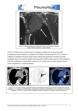 Figura 15. RM demonstrando neoplasia pulmonar do sulco superior esquerdo 
(seta) invadindo a pleura e o plexo braquial. 
A PET é um método novo e muito promissor na avaliação e estadiamento do câncer de pulmão, 
principalmente quando acoplada a um aparelho de tomografia computadorizada (PET-CT). Consiste na 
avaliação do metabolismo de glicose pelas células, estando este geralmente aumentado nas células 
neoplásicas (figura 16). Apesar de também poder apresentar resultados falsos-positivos e falsos-negativos, 
a PET tem sensibilidade e especificidade superiores à TC na maior parte dos casos, podendo inclusive 
mudar o prognóstico e a conduta terapêutica. 
Figura 16. A. TC demonstrando opacidade irregular paramediastinal esquerda, que poderia corresponder a foco de 
atelectasia ou a neoplasia. B. A PET isolada mostra hiperconcentração do radiofármaco, mas não precisa com clareza a 
topografia. C. A PET-CT permite melhor avaliação da lesão, ao acoplar as 2 imagens. Carcinoma pulmonar. 
Curso Pneumo Atual de Tomografia computadorizada do tórax – aula 06 9 
 