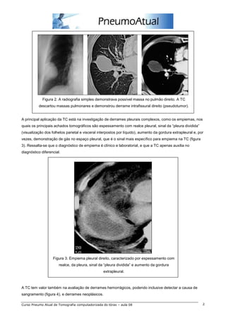 Figura 2. A radiografia simples demonstrava possível massa no pulmão direito. A TC 
descartou massas pulmonares e demonstrou derrame intrafissural direito (pseudotumor). 
A principal aplicação da TC está na investigação de derrames pleurais complexos, como os empiemas, nos 
quais os principais achados tomográficos são espessamento com realce pleural, sinal da “pleura dividida” 
(visualização dos folhetos parietal e visceral interpostos por líquido), aumento da gordura extrapleural e, por 
vezes, demonstração de gás no espaço pleural, que é o sinal mais específico para empiema na TC (figura 
3). Ressalta-se que o diagnóstico de empiema é clínico e laboratorial, e que a TC apenas auxilia no 
diagnóstico diferencial. 
Figura 3. Empiema pleural direito, caracterizado por espessamento com 
realce, da pleura, sinal da “pleura dividida” e aumento da gordura 
extrapleural. 
A TC tem valor também na avaliação de derrames hemorrágicos, podendo inclusive detectar a causa de 
sangramento (figura 4), e derrames neoplásicos. 
Curso Pneumo Atual de Tomografia computadorizada do tórax – aula 08 2 
 