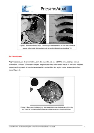 Figura 4. Hemotórax esquerdo, causado por sangramento de um aneurisma de 
artéria, intercostal demonstrado na reconstrução tridimensional na TC. 
3 – Pneumotórax 
As principais causas de pneumotórax, além dos espontâneos, são a DPOC, asma, doenças císticas 
pulmonares e fibrose. A radiografia simples diagnostica a maior parte deles, mas a TC tem valor naqueles 
pequenos ou em casos de dúvida na radiografia. Permite ainda, em alguns casos, a detecção do fator 
causal (figura 5). 
Figura 5. Pequeno pneumotórax apical esquerdo decorrente de ruptura de 
um cisto no lobo superior ipsilateral em paciente com pneumocistose. 
Curso Pneumo Atual de Tomografia computadorizada do tórax – aula 08 3 
 