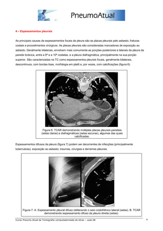 4 – Espessamentos pleurais 
As principais causas de espessamentos focais da pleura são as placas pleurais pelo asbesto, fraturas 
costais e procedimentos cirúrgicos. As placas pleurais são consideradas marcadoras de exposição ao 
asbesto. Geralmente bilaterais, envolvem mais comumente as porções posteriores e laterais da pleura da 
parede torácica, entre a 6ª e a 10ª costelas, e a pleura diafragmática, principalmente na sua porção 
superior. São caracterizadas na TC como espessamentos pleurais focais, geralmente bilaterais, 
descontínuos, com bordas lisas, morfologia em platô e, por vezes, com calcificações (figura 6). 
Figura 6. TCAR demonstrando múltiplas placas pleurais parietais 
(setas claras) e diafragmáticas (setas escuras), algumas das quais 
calcificadas. 
Espessamentos difusos da pleura (figura 7) podem ser decorrentes de infecções (principalmente 
tuberculose), exposição ao asbesto, traumas, cirurgias e derrames pleurais. 
Figura 7. A. Espessamento pleural difuso obliterando o seio costofrênico lateral (setas). B. TCAR 
demonstrando espessamento difuso da pleura direita (setas). 
Curso Pneumo Atual de Tomografia computadorizada do tórax – aula 08 4 
 