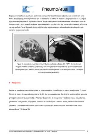 Espessamentos focais ou difusos podem se acompanhar de atelectasia redonda, que consiste em uma 
forma de colapso pulmonar periférico que se apresenta na forma de massa. É diagnosticada na TC (figura 
8) quando empregados os seguintes critérios: a opacidade parenquimatosa deve ser redonda ou oval, ter 
íntimo contato com a superfície pleural, estar associada com distorção dos vasos pulmonares ou brônquios 
na sua periferia (“sinal da cauda de cometa”) e estar relacionada com alteração pleural adjacente, seja 
derrame ou espessamento. 
Figura 8. Atelectasia redonda em indivíduo exposto ao asbesto. (A) TCAR demonstrando 
imagem nodular periférica (asterisco), com redução volumétrica lobar e opacidades lineares 
convergentes para a lesão (setas). (B) Espessamento pleural focal (seta) adjacente à imagem 
nodular pulmonar (asterisco). 
5 – Neoplasias 
Dentre as neoplasias pleurais benignas, as principais são o tumor fibroso da pleura e os lipomas. O tumor 
fibroso da pleura é responsável por cerca de 5% dos tumores pleurais. Geralmente assintomático, acomete 
principalmente indivíduos entre 50 a 70 anos. Os achados de imagem na TC são de massa pleural única, 
geralmente com grandes proporções, podendo ter calcificações e intenso realce pelo meio de contraste 
(figura 9). Lipomas são neoplasias com conteúdo gorduroso, tendo contornos bem definidos e baixa 
atenuação na TC (figura 10). 
Curso Pneumo Atual de Tomografia computadorizada do tórax – aula 08 5 
 