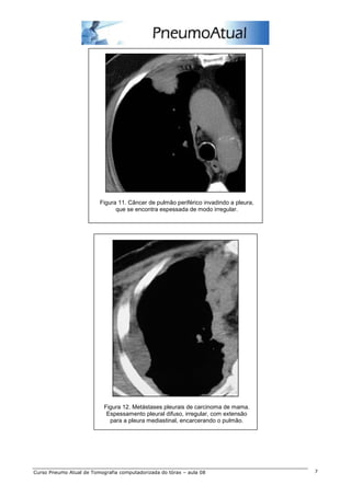 Figura 11. Câncer de pulmão periférico invadindo a pleura, 
que se encontra espessada de modo irregular. 
Figura 12. Metástases pleurais de carcinoma de mama. 
Espessamento pleural difuso, irregular, com extensão 
para a pleura mediastinal, encarcerando o pulmão. 
Curso Pneumo Atual de Tomografia computadorizada do tórax – aula 08 7 
 