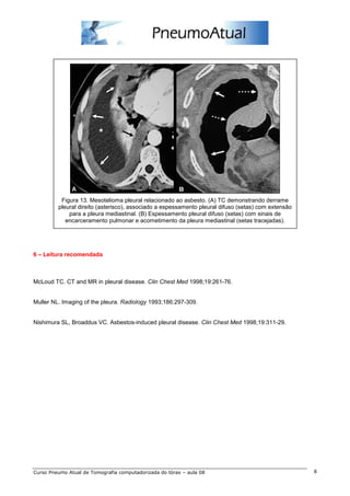 Figura 13. Mesotelioma pleural relacionado ao asbesto. (A) TC demonstrando derrame 
pleural direito (asterisco), associado a espessamento pleural difuso (setas) com extensão 
para a pleura mediastinal. (B) Espessamento pleural difuso (setas) com sinais de 
encarceramento pulmonar e acometimento da pleura mediastinal (setas tracejadas). 
6 – Leitura recomendada 
McLoud TC. CT and MR in pleural disease. Clin Chest Med 1998;19:261-76. 
Muller NL. Imaging of the pleura. Radiology 1993;186:297-309. 
Nishimura SL, Broaddus VC. Asbestos-induced pleural disease. Clin Chest Med 1998;19:311-29. 
Curso Pneumo Atual de Tomografia computadorizada do tórax – aula 08 8 
