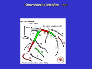Koszorúerek lefutása - bal 